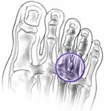 ภาพจาก American Academy of Orthopaedic Surgeons