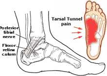 ภาพซ้ายจาก foothealthfacts.org ภาพขวาจาก delhifootankleclinic.com